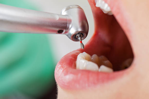 Best Emergency Gum Treatment in Winter Haven, FL